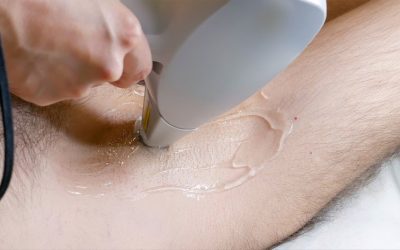 Epilation homme: quelle solution choisir ?